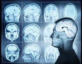 MRI מוח (MRI ראש)